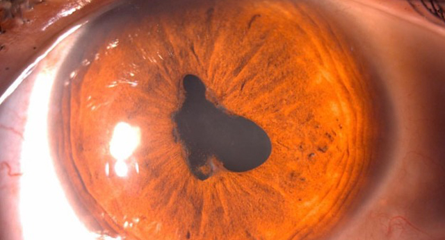 sinequia ocular tratamiento