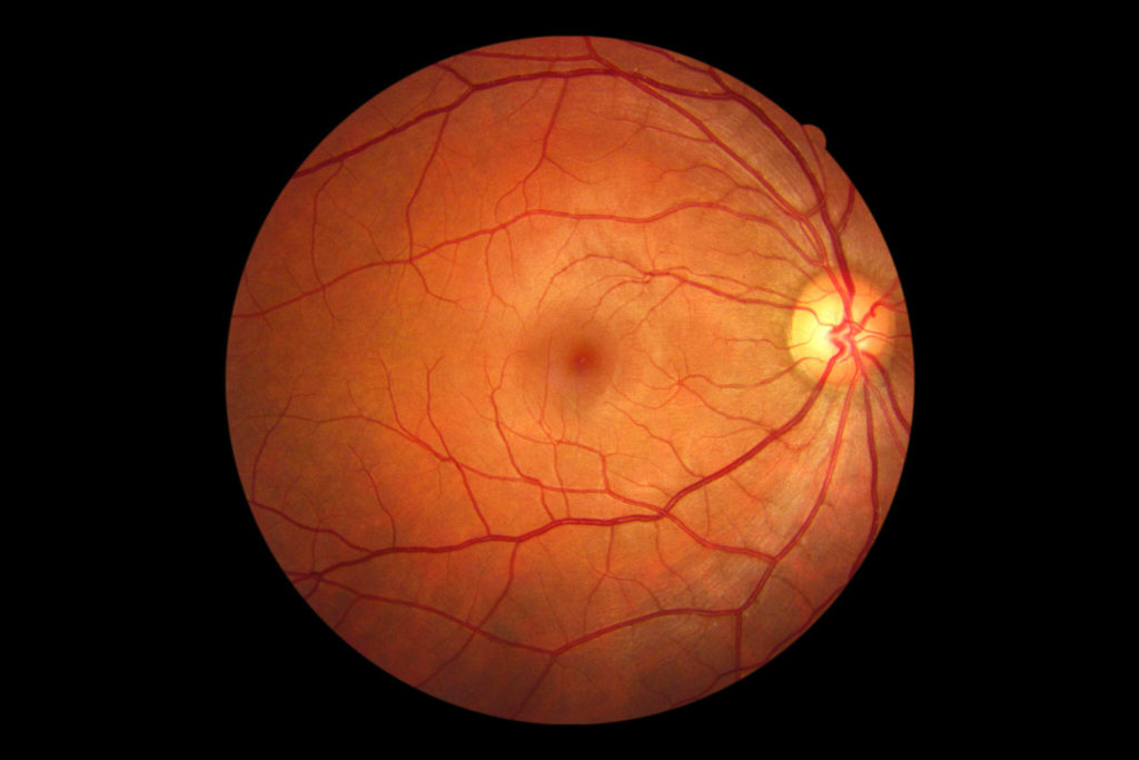 Desprendimiento de Retina: Causas, síntomas y tratamiento