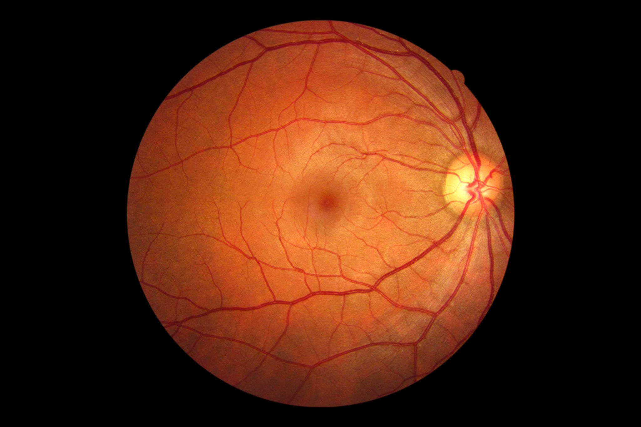 desprendimiento retina