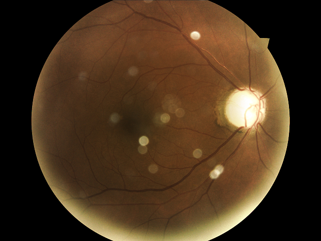 imagen hipertensión ocular
