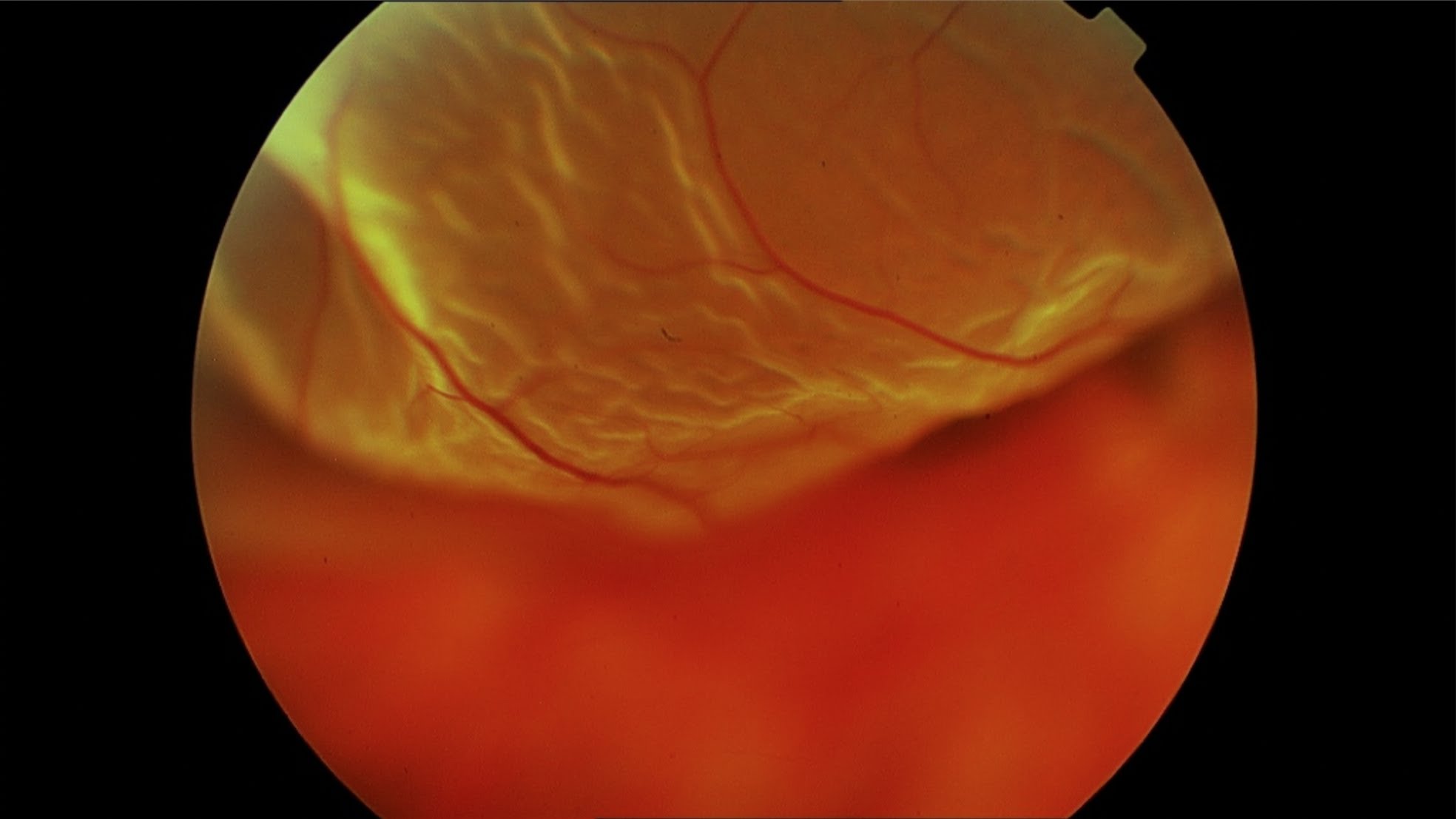 operación retina y vítreo