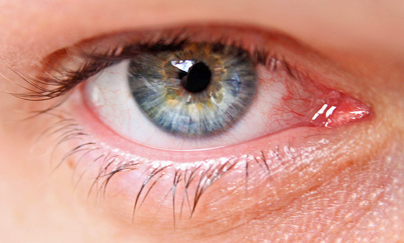 tensión ocular glaucoma