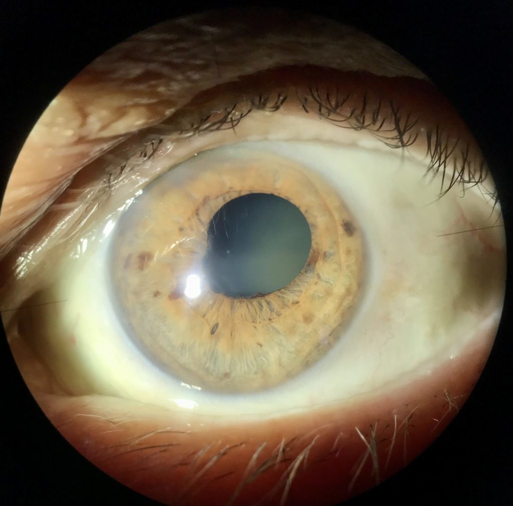 ¿Qué son las sinequias oculares?